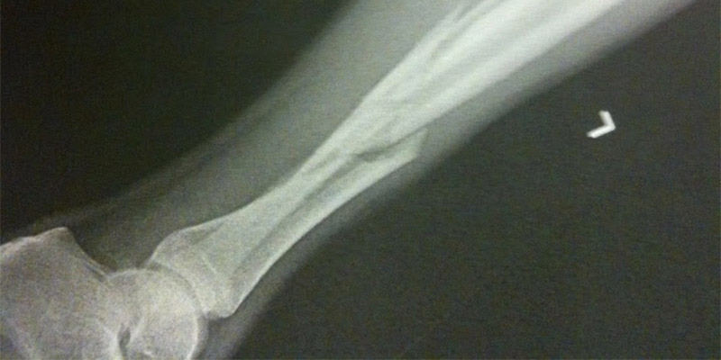 2011 - Bone Fracture